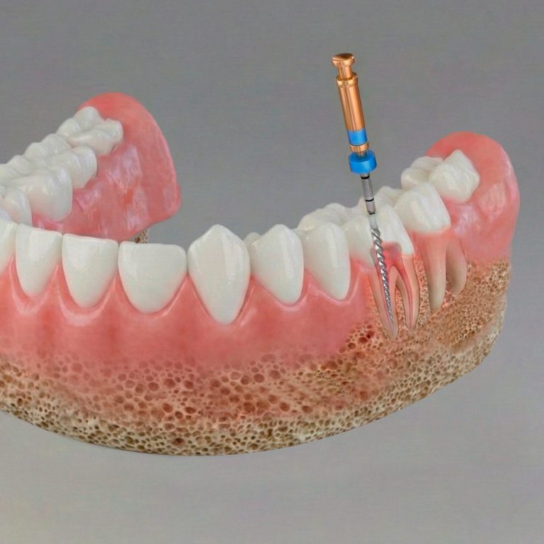 endodoncia